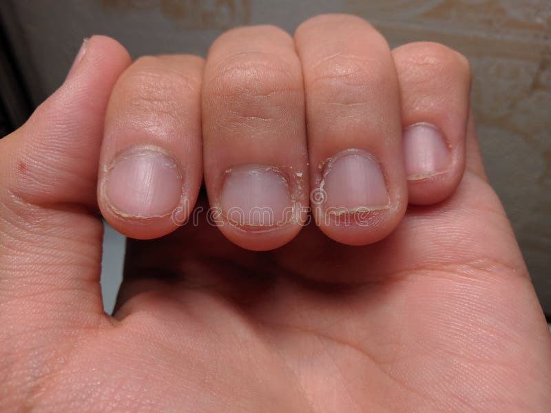 Unkempt hand with fingers. Fingers with cuticles and bad nails.