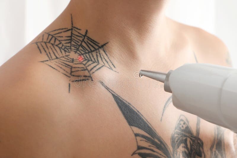 Uomo che subisce procedura di rimozione del tatuaggio del laser in salone