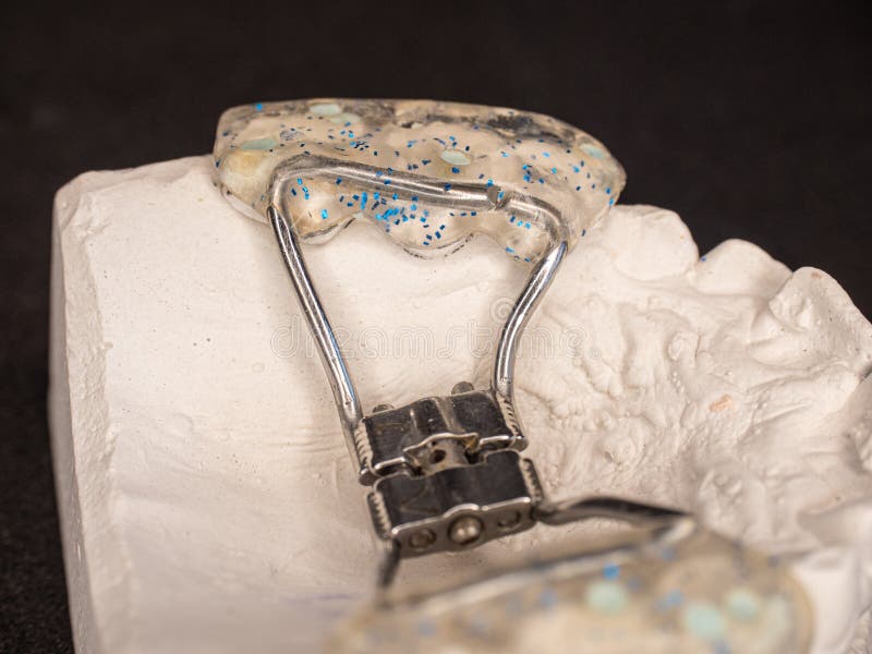 Upper Jaw Bracket Braces Model on Dentist Table Stock Image Image of