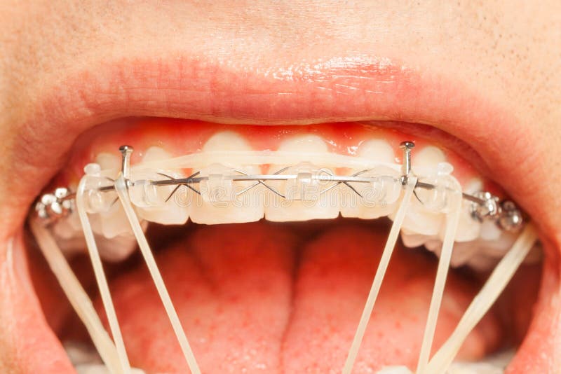 Rubber Strings Teeth Correction Braces Stock Photos Free & Royalty