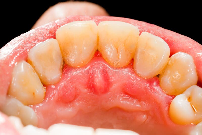 Upper Teeth stock image. Image of health, gingiva, gums - 35668997