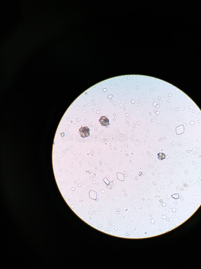 Urine Crystals, Red Blood Cells and Leukocytes at the Microscope. Urinary Tract Disease in Cat
