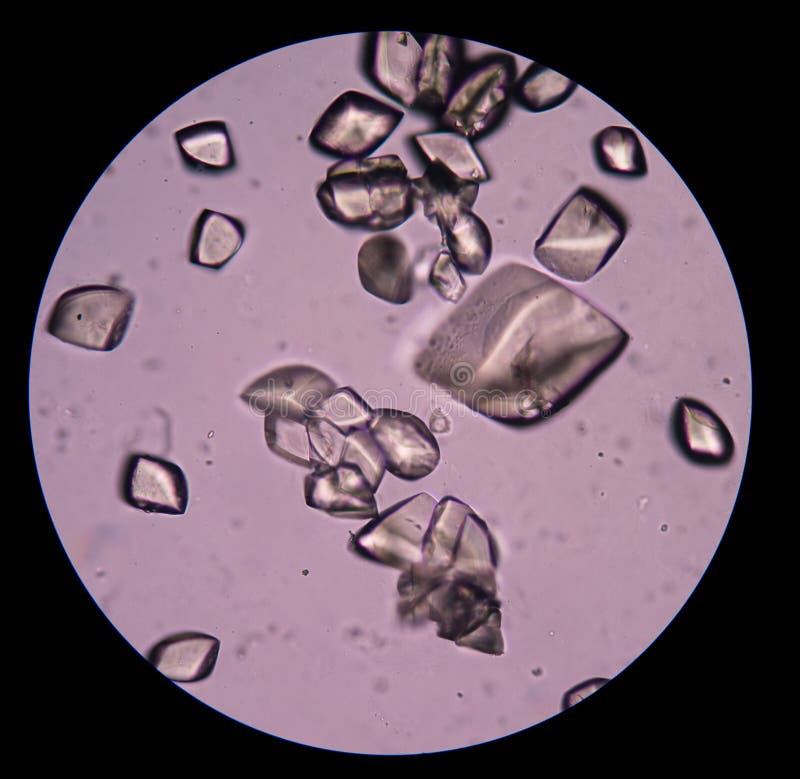 Uric acid in urine sediment