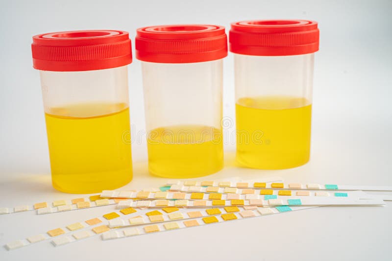 Urinalysis, Urine Cup with Reagent Strip PH Paper Test and Comparison