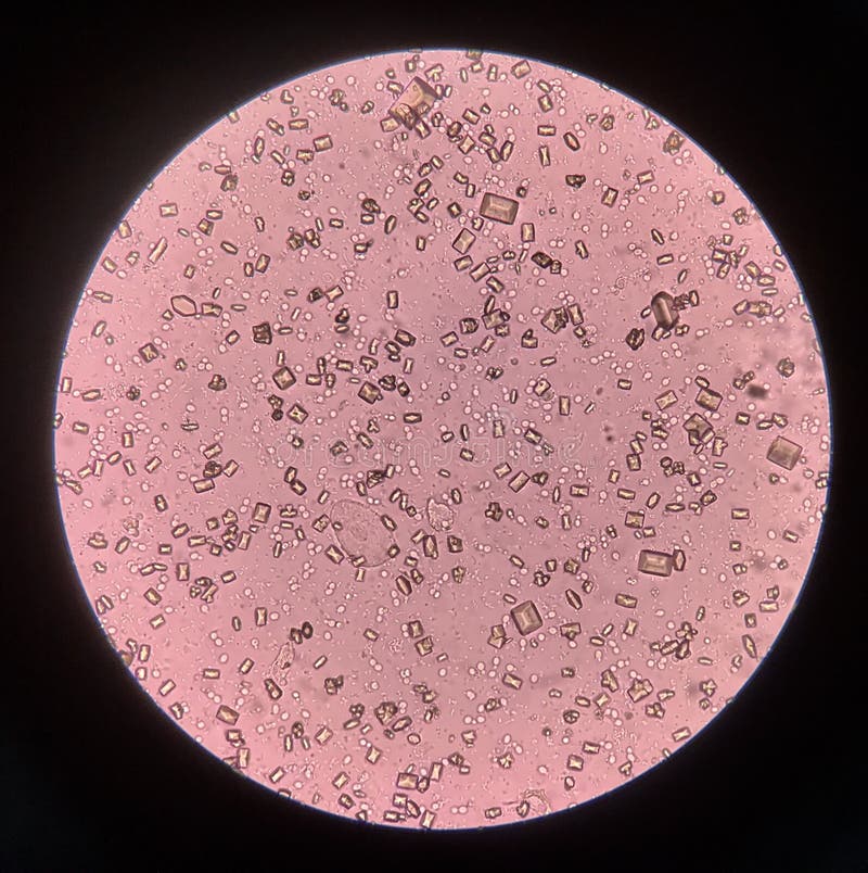 Urine Analysis Finding with Microscope Show Crystal Bacteria and
