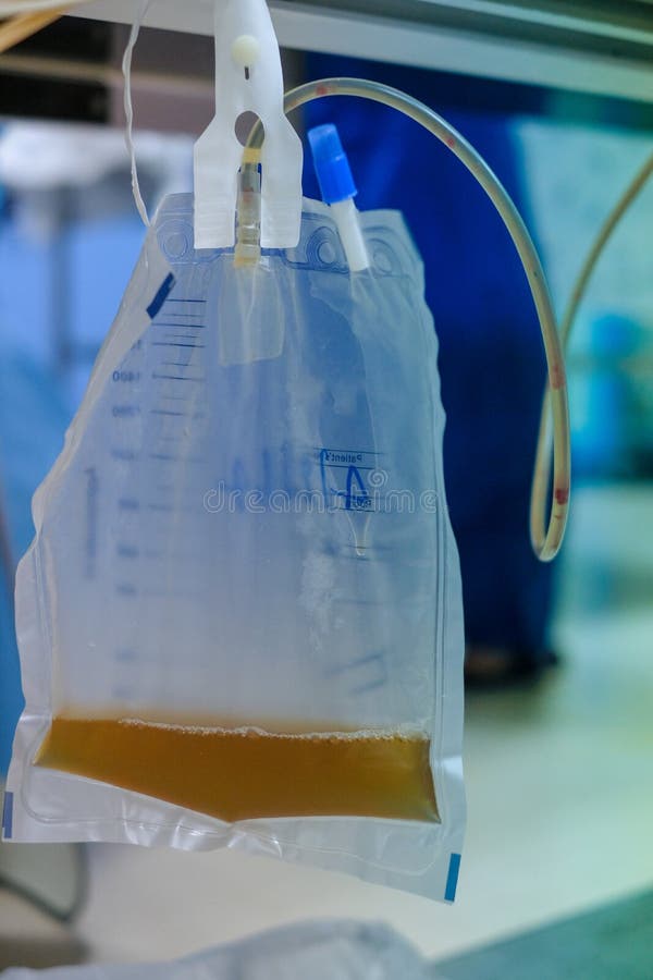 Urine Bag Hanging beside the Patient`s Bed. Stock Image - Image of ...