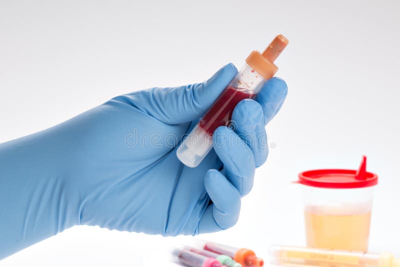 Urine and Blood Test Blood Count) Stock Photo Image of