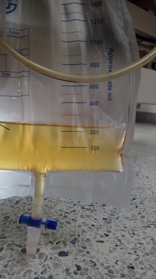 Urine Plstic Bag Hanking beside Patient Bed in Hospital with Some Urine ...