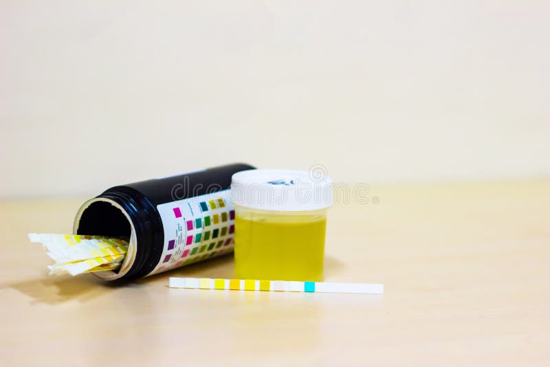Urine Sample Along with Dip Stick Uristix for Analyzing Urine Glucose