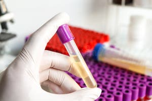 Urine Test To Look For Abnormalities From Urine Urine Sample To 