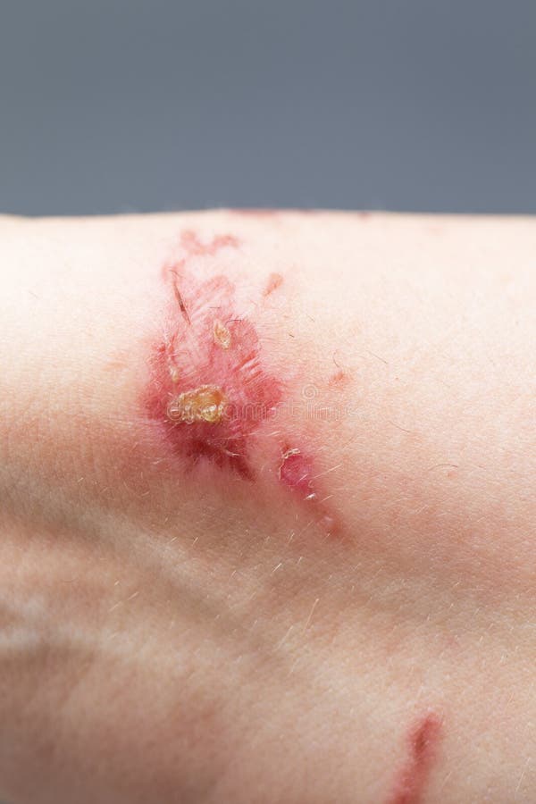Ustione Chimica Sulla Pelle Del Polso Con Acido Idrossido Di Sodio Mediante Striatura Di Vernice