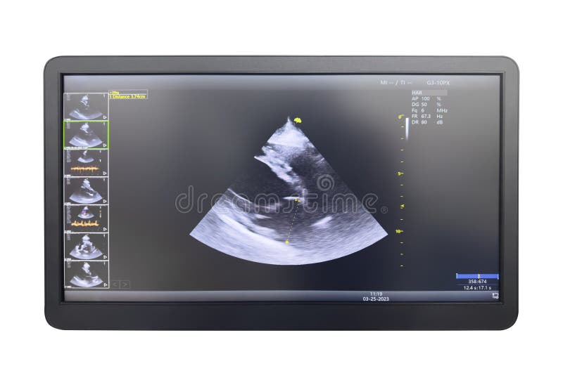 Utrasound image on the monitor close-up. Ultrasound scan examination on display. Screening ultrasonography analysis. Echocardiography.