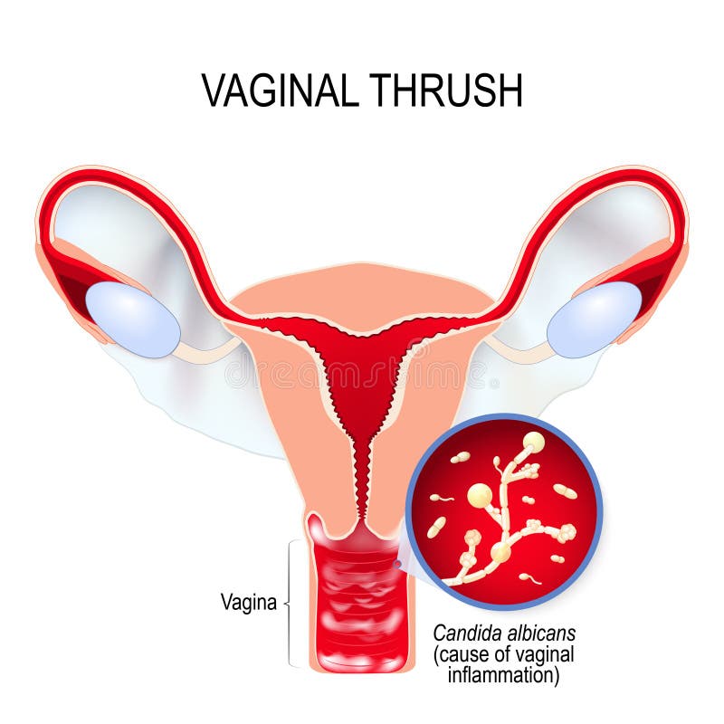 Is Yeast Infection Thrush Queens