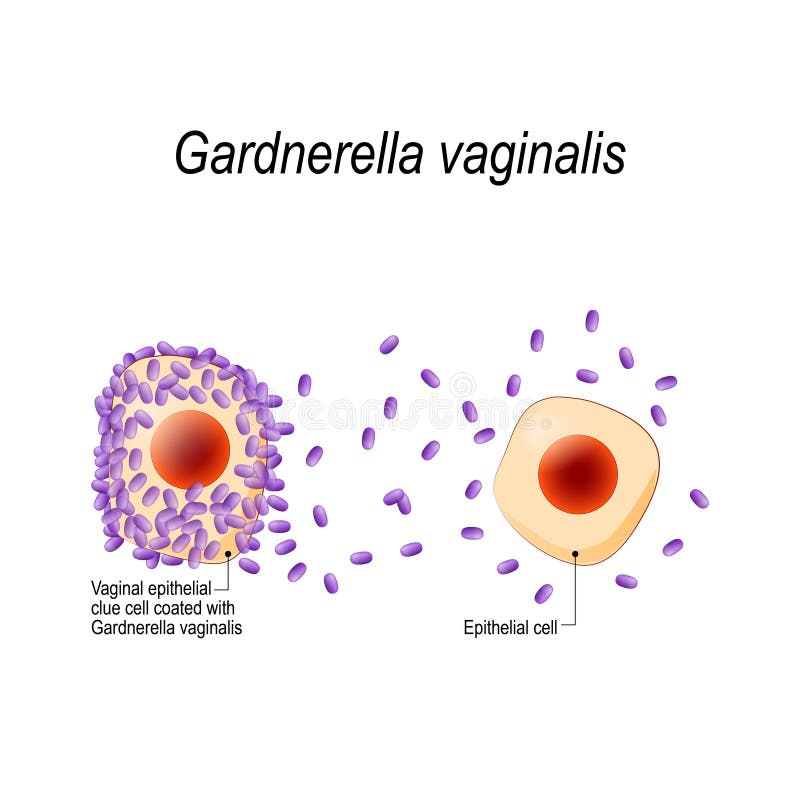 Vaginalis de Gardnerella Célula epitelial vaginal de la pista cubierta con las bacterias