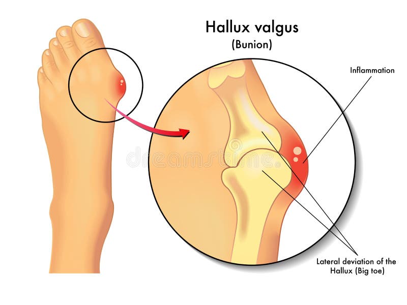 Valgus de Hallux illustration stock Valgus de Hallux illustration stock