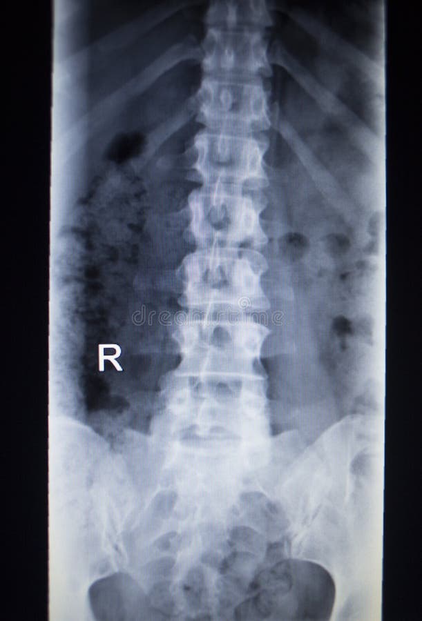 X-ray orthopedic medical CAT scan of painful lower back spine injury in Traumatology hospital clinic. X-ray orthopedic medical CAT scan of painful lower back spine injury in Traumatology hospital clinic.