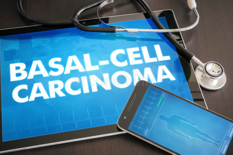 Van het basis-celcarcinoom (kankertype) de diagnose medisch concept royalty-vrije stock afbeeldingen Van het basis-celcarcinoom (kankertype) de diagnose medisch concept royalty-vrije stock afbeeldingen