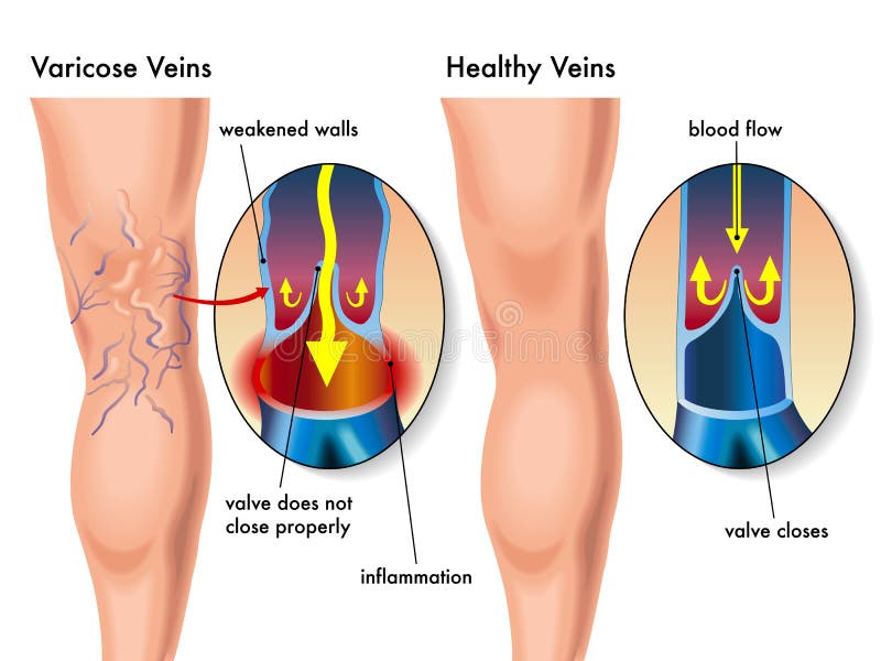 Illustrazione medica degli effetti delle vene varicose.