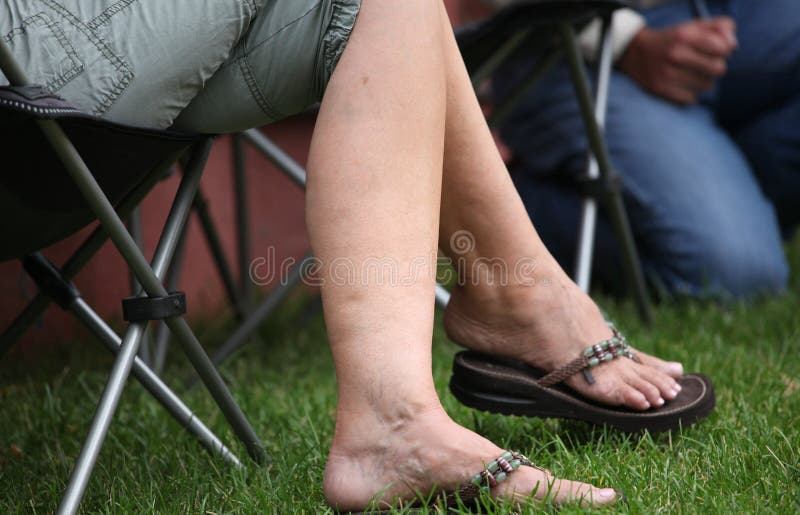 femeie varicose foot)