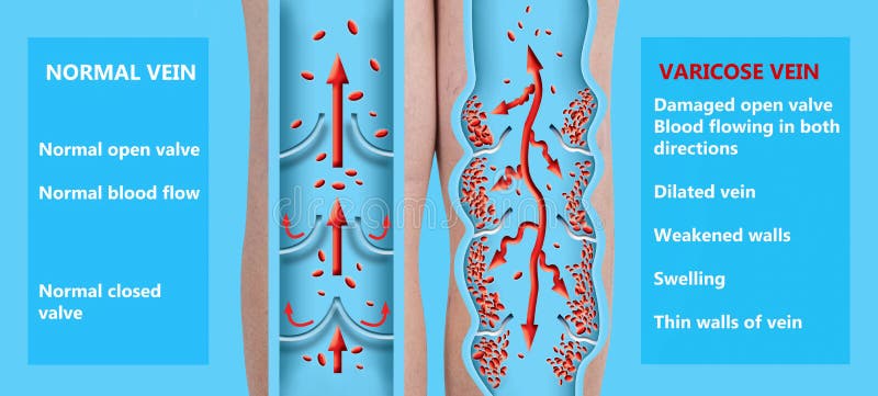 Varicose veins on a female senior legs. The structure of normal and varicose veins. royalty free illustration Varicose veins on a female senior legs. The structure of normal and varicose veins. royalty free illustration