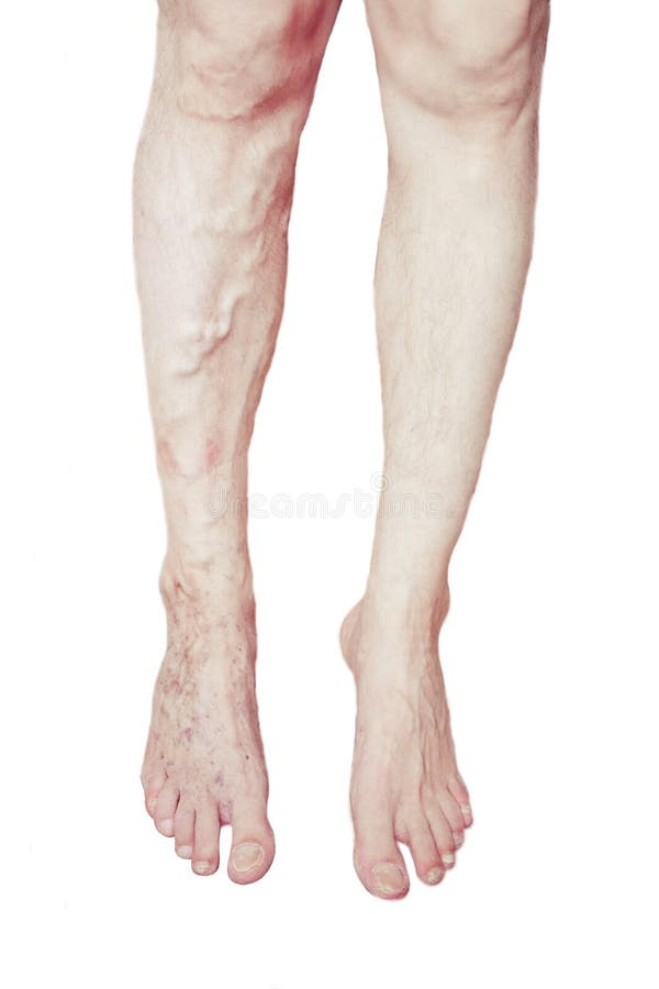 Varicose Veins on the leg royalty free stock photos Varicose Veins on the leg royalty free stock photos