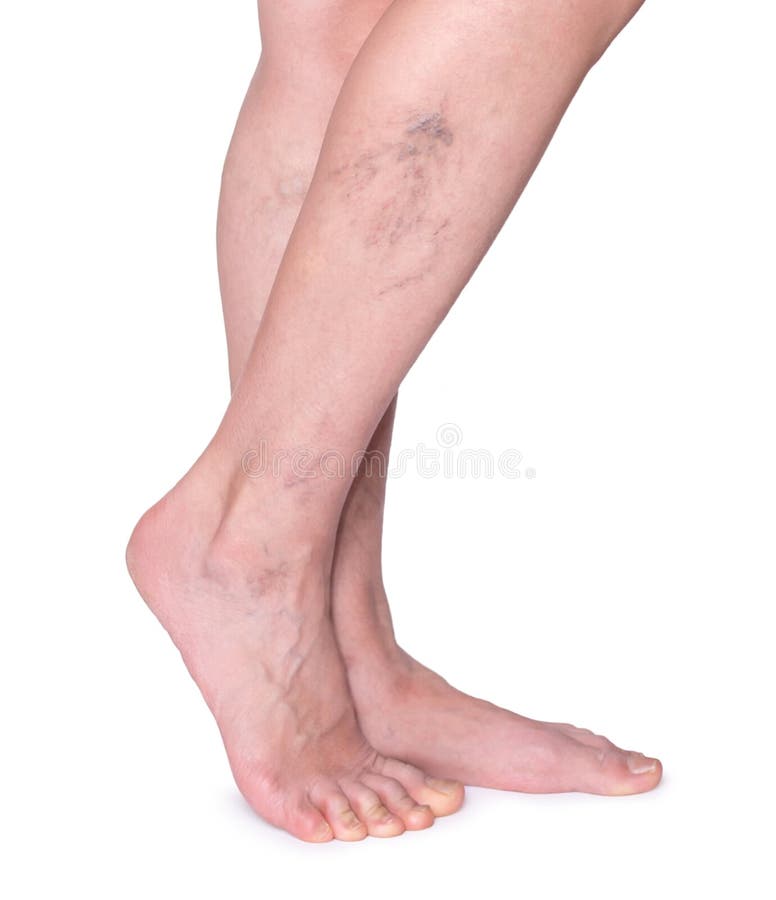Varicose veins in the legs. Woman legs isolated on white.