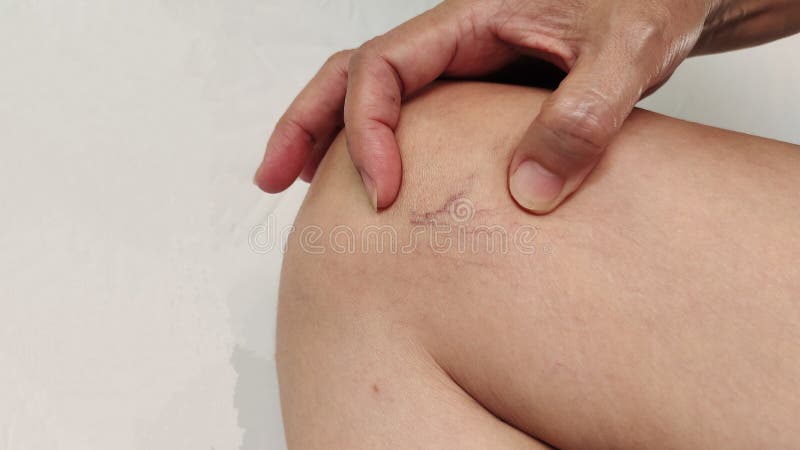 Portrait showing the hand holding the varicose spider veins on the leg of the woman, problem wrinkle and circulation of blood, health care and medical concept. Problem wrinkle stock images, royalty-free photos and pictures
