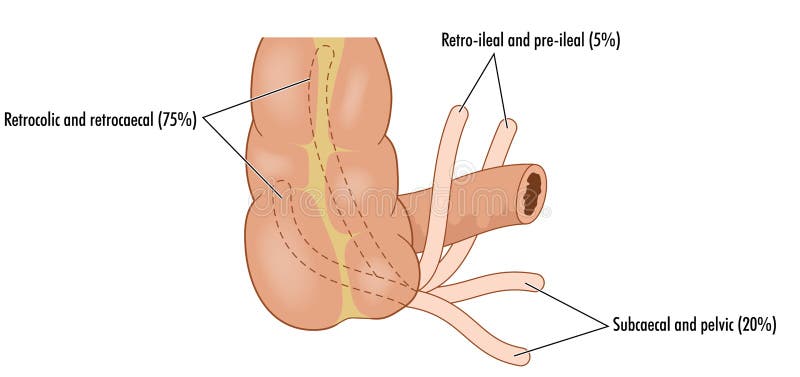 Various appendix locations stock illustration