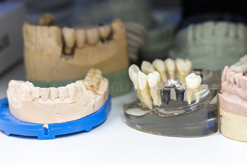 Various Dental Cast Models. Focus on Cast Model with Teeth Implants