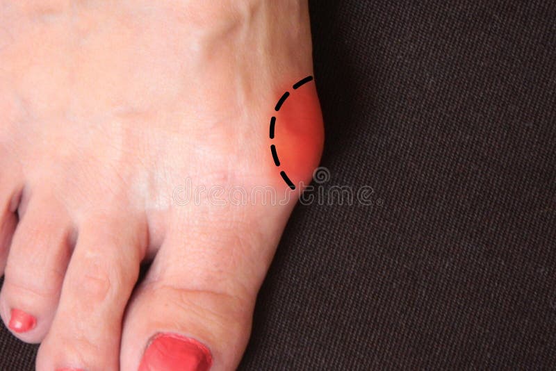 Varus valgus och Hallux valgus eller bunion på mellersta åldrig kvinnafot Isolerad closeup på mörk bakgrund Begrepp av behandling arkivbilder Varus valgus och Hallux valgus eller bunion på mellersta åldrig kvinnafot Isolerad closeup på mörk bakgrund Begrepp av behandling arkivbilder