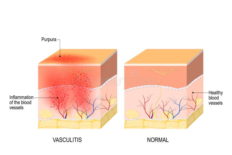 Vasculitis Tvärsnitt av den mänskliga huden med vasculitis stock illustrationer Vasculitis Tvärsnitt av den mänskliga huden med vasculitis stock illustrationer