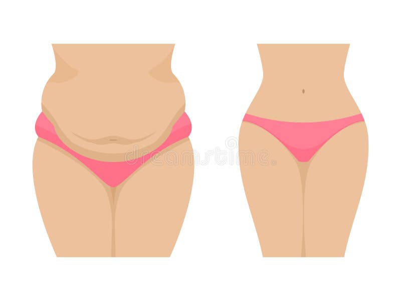 Vector illustration of a fat and thin female belly. Isolated white background. Human abdomen before and after losing weight. Flat style. Vector illustration of a fat and thin female belly. Isolated white background. Human abdomen before and after losing weight. Flat style.