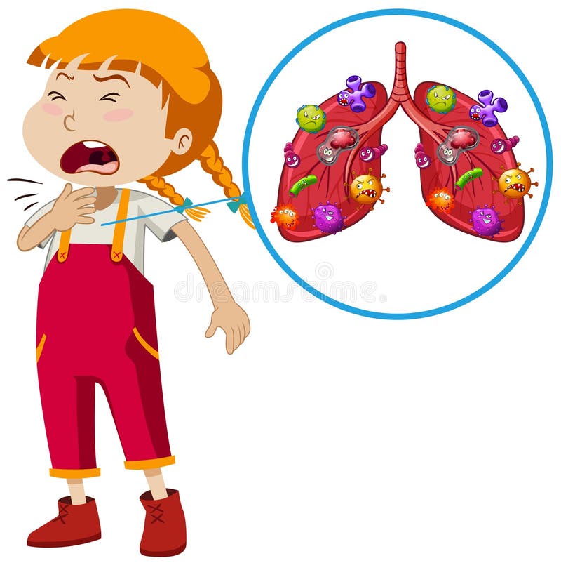 A Vector of Girl Lung Infection vector illustration A Vector of Girl Lung Infection vector illustration