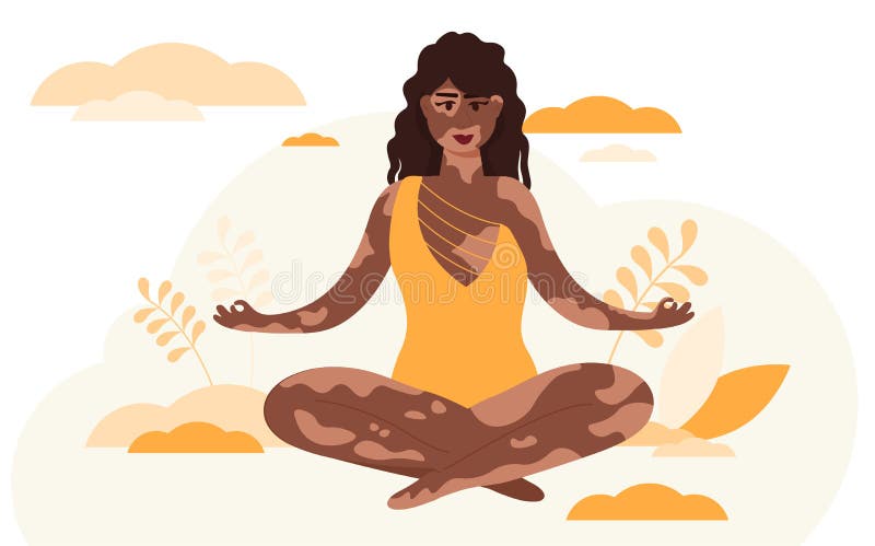 Vector illustration of a beautiful woman with a Vitiligo.Love yourself.Body positive.