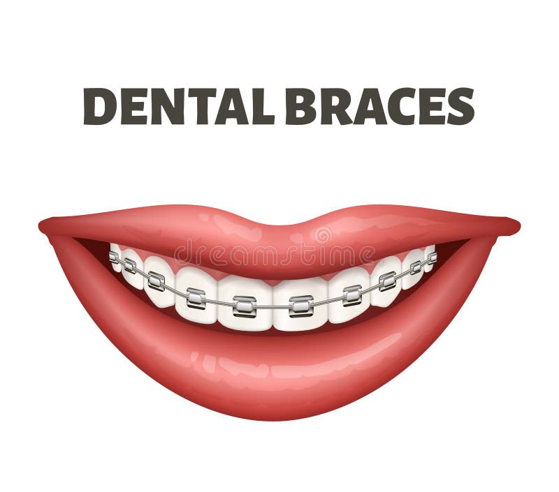 Download Braces Smile stock vector. Illustration of braces ...