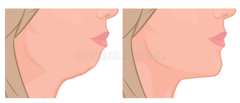 Face side view_Chin Augmentation 2