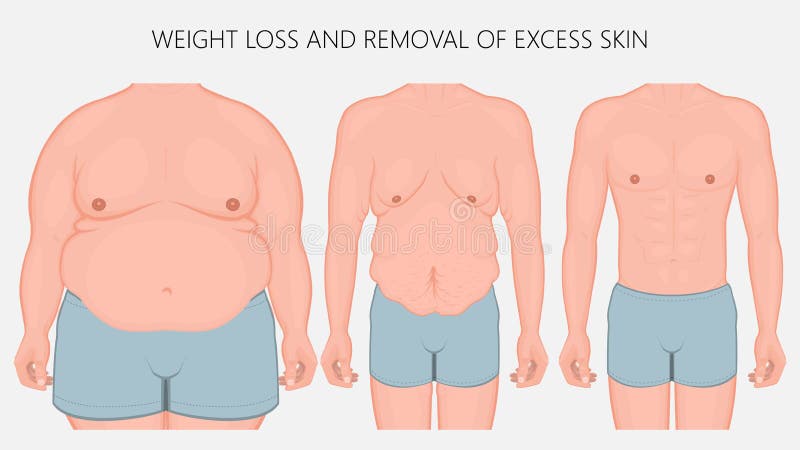 Human body problem_Weight loss and removal of excess skin front