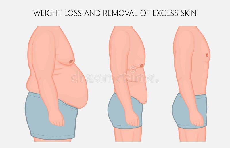 Human body problem_Weight loss and removal of excess skin side v