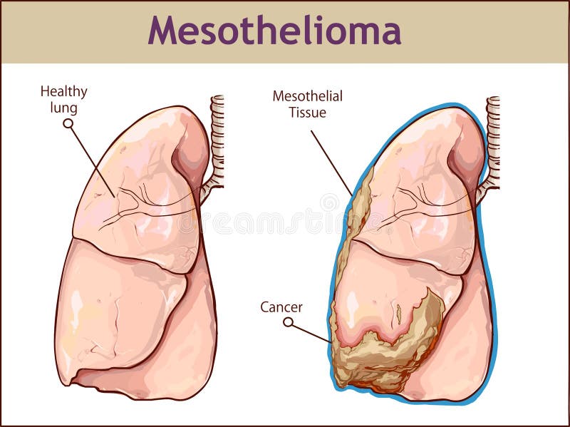 mesothelioma lawyer new