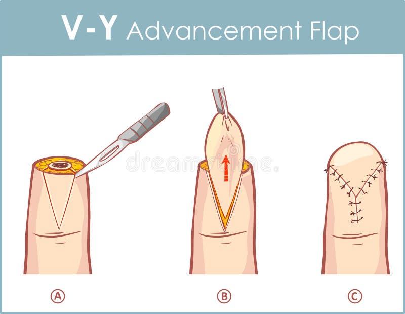 Vector Illustration Of A V Y Advancement Flap Stock Vector Illustration Of Injuries Amputations