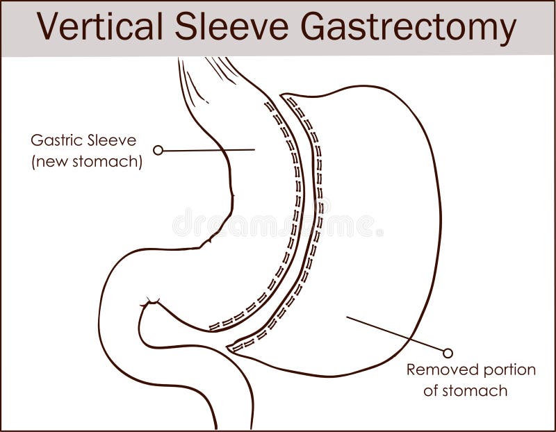 Vector illustration of Vertical Sleeve Gastrectomy vector illustration Vector illustration of Vertical Sleeve Gastrectomy vector illustration