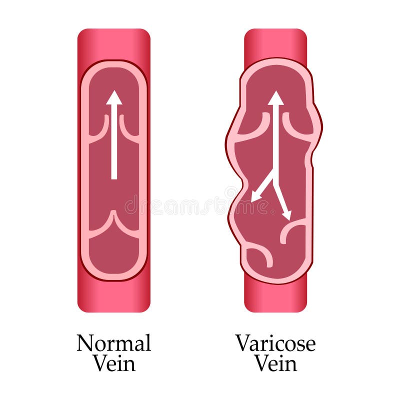 Vector varicose vein and normal vein. Varicose vein. vector illustration Vector varicose vein and normal vein. Varicose vein. vector illustration
