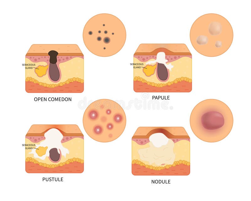 Vectortypes van acne stock illustratie Vectortypes van acne stock illustratie
