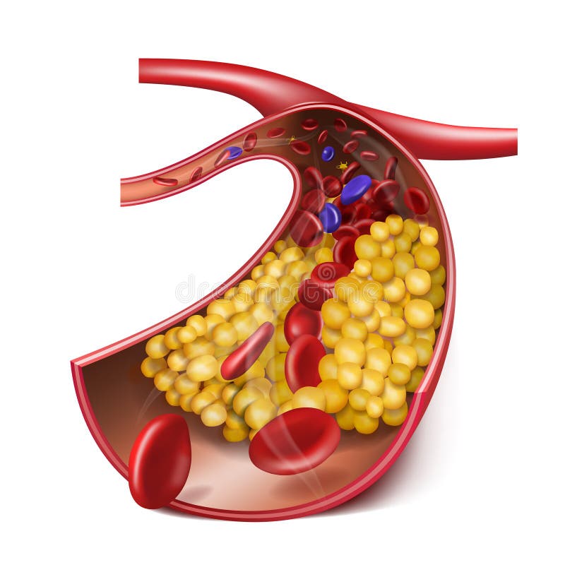 Vein with high cholesterol levels. Medical illustration. 3d vector. Vein with high cholesterol levels. Medical illustration. 3d vector