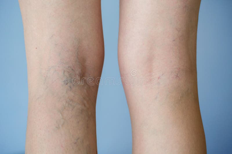Veines variqueuses photos libres de droits Veines variqueuses photos libres de droits