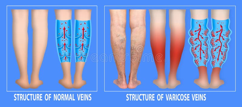 Cum se tratează picioarele varicoase și edeme, Varice - cauze, simptome si tratament