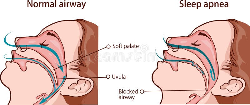 VECTOR ILLUSTRATION OF A SLEEP APNEA SYNDROME. VECTOR ILLUSTRATION OF A SLEEP APNEA SYNDROME.