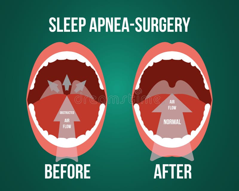 Vector illustration of surgery for obstructive sleep apnea, before and after result. Vector illustration of surgery for obstructive sleep apnea, before and after result.
