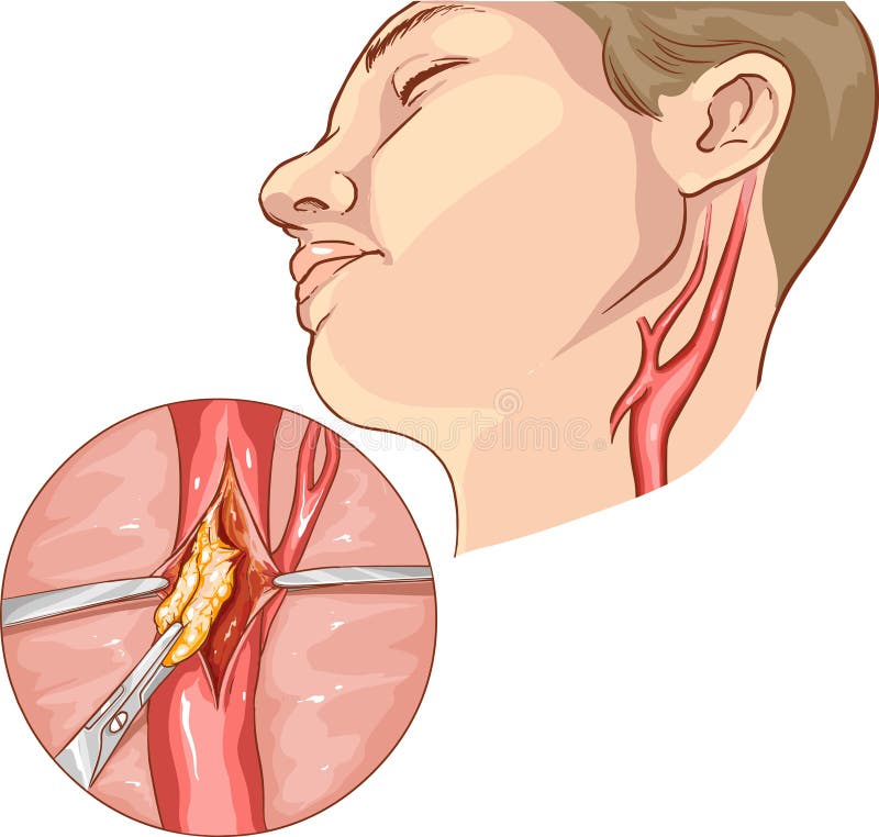 Vektorillustration eines Karotisendarterectomy