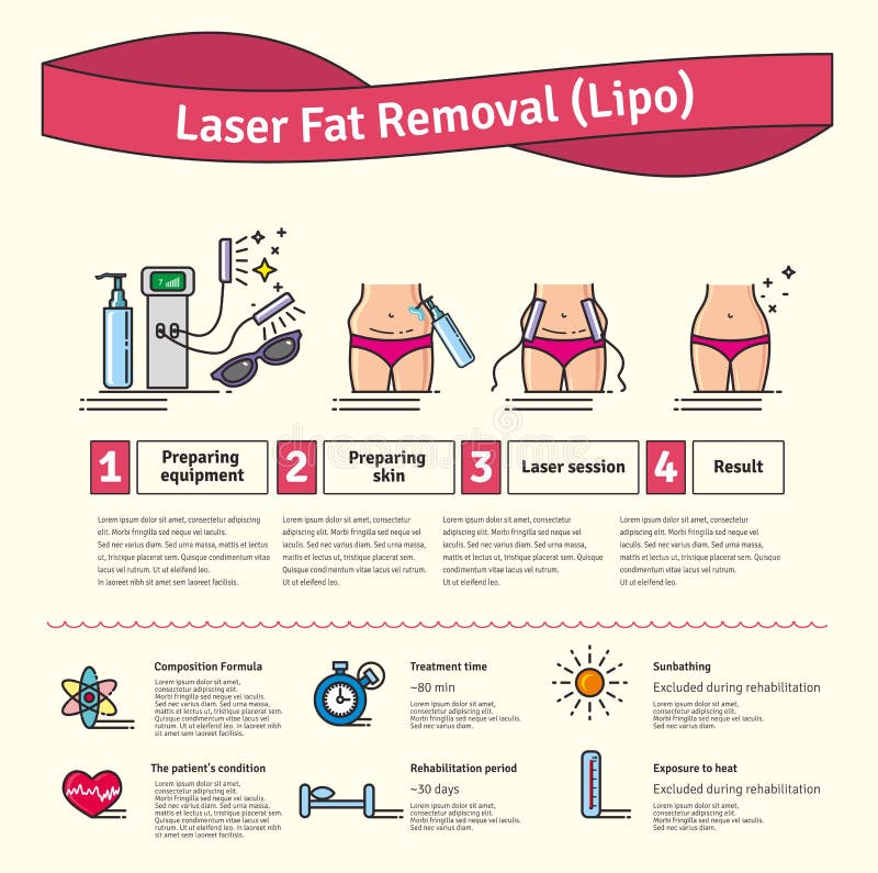 Vektorn illustrerade uppsättningen med fettborttagning för laser LIPO stock illustrationer Vektorn illustrerade uppsättningen med fettborttagning för laser LIPO stock illustrationer